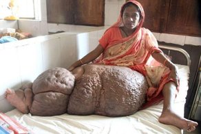 Нога женщины стала весить 60 килограмм