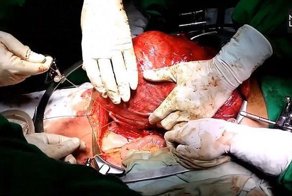 Хирурги удалили самую большую в мире опухоль из почки женщины
