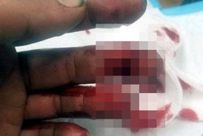 Мужчина травмировал пальцы прессом