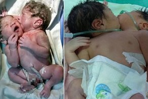 В Индии появился на свет младенец с двумя головами