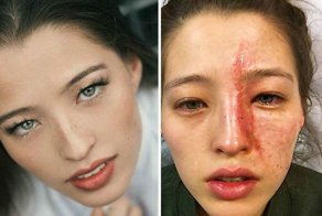 Девушка получила ожог лица используя увлажнитель воздуха с эфирными маслами