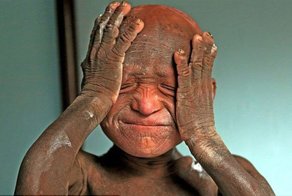 Через 15 дней после рождения с ребенка начала слезать кожа