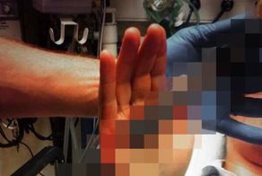 Женщина проколола свою руку ножом