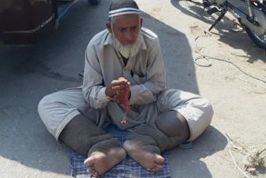 Ужасная болезнь: Мужчина-слон мечтает об операции