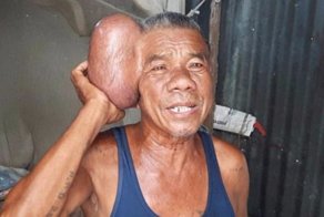 «Человек с двумя головами» - опухоль на голове у тайского пенсионера