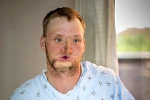 Через 10 лет после попытки самоубийства мужчина получил новое лицо