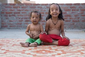 Семейная трагедия: сразу двое детей страдают от прогерии