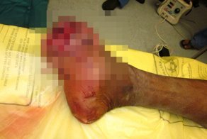 Травматическая ампутация передней части стопы