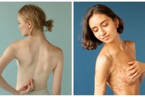 Фотопроект: люди показывают свои шрамы и рассказывают о том, как их получили