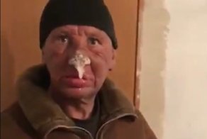 Житель Казахстана получил жуткое обморожения после недели, проведенной на улице