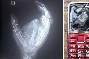 12-летний мальчик остался без пальца и ослеп на один глаз после того, как его телефон взорвался во время зарядки