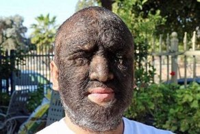 Это самый волосатый мужчина в мире: 98% его тела покрыты густыми темными волосами