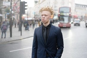 Модель-альбинос ответил тем, кто его травил, снявшись для Vogue