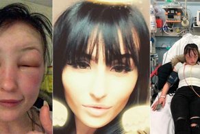 Девушку трижды госпитализировали после домашней покраски волос