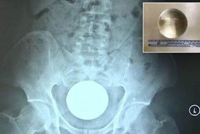 Китайца доставили в больницу с 8-сантиметровым шаром в прямой кишке