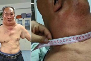 30 лет пьянства превратили мужчину в «Халка»