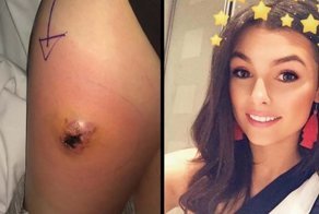 Страх потерять ногу после укуса паука заставил 19-летнюю девушку обратиться к врачам