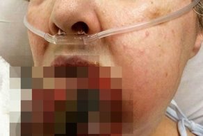 Язык женщины, укушенный ядовитый пауком