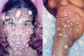 Тело женщины покрылось тысячами опухолей после рождения второго ребенка