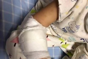Китайским врачам пришлось хирургически удалять резиновое кольцо, вросшее ребенку под кожу
