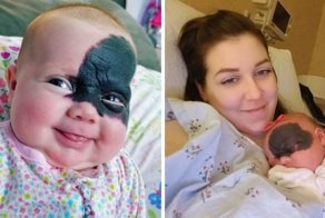 Малышка родилась с огромным пятном на лице, но родители не спешат его удалять!