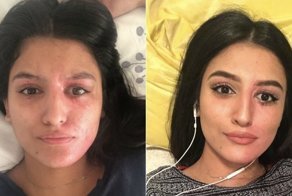 Эту девушку облили кислотой, но после операций она стала выглядеть ещё красивее