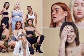 Модели с проблемами кожи собрались для крутой фотосессии, и они прекрасны как никогда