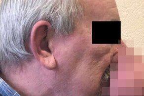 Петербургские медики отрезали мужчине полукилограммовую часть носа