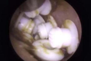 Это что-то невероятное: у мужчины из уха извлекли 22 предмета