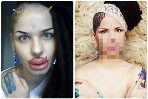 Помните россиянку, которая сделала 100 инъекций в губы? Просто взгляните, что с ней стало сегодня