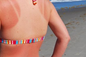 Мать двоих детей нашла безотказное средство от солнечных ожогов