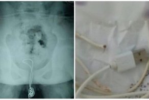 Китайский подросток засунул в свой пенис USB-кабель