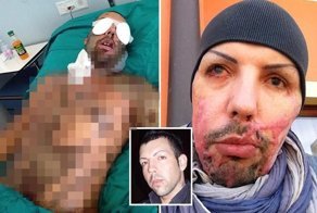 Девушка облила бывшего парня соляной кислотой