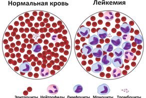 Свершилось! Медики "убили" неизлечимый рак крови и печени