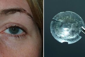 Из века женщины достали контактную линзу, которая пробыла там почти 30 лет