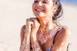 15 удивительных людей с витилиго, от которых сложно оторвать взгляд