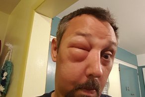 12 печальных раз, которых аллергия застала врасплох и кардинально изменила лица
