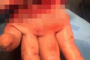 Последствия неосторожного обращения с циркулярной пилой