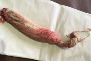 Врачи достали из живота мужчины марлю, забытую там год назад