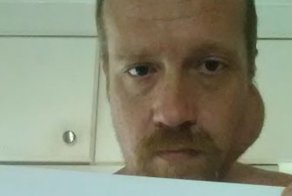 Парень с опухолью стал объектом злых шуток, и ему это понравилось