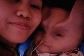 На голове двухлетнего малыша после операции появились "рога дьявола"