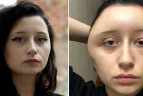 Аллергия на краску для волос превратила студентку в "лампочку"