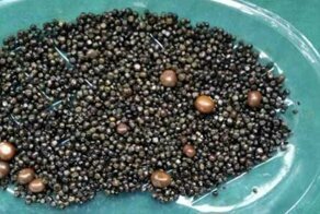 У любительницы жирной пищи обнаружили 2 тысячи желчных камней