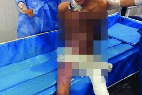 Серьезные высоковольтные электрические ожоги у юноши