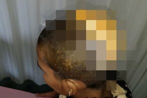 Потеря скальпа затылочной области