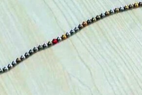 12-летнему мальчику удалили 39 железных шариков из пениса