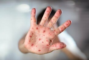 Корь проникает в квартиры самыми необычными способами