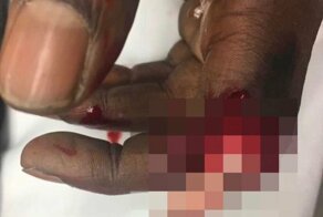 Случай травматической ампутации указательного пальца