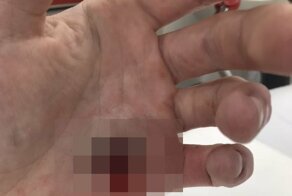 Хирург промывает простреленную насквозь ладонь