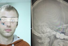 Стальной болт пробил череп сибиряку и чуть не оставил его без глаза